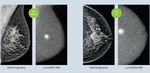 A comparison between mammography vs. molecular breast imaging (MBI).