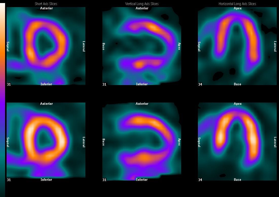 A SPECT nuclear scan of the heart to show perfusion defects in the myocardium due to coronary artery blockages or heart attack. The imaging uses the Mo-99 based medical imaging isotope Tc-99m. The U.S. government has created policy to move away from use of highly enriched uranium (HEU) to low-enriched uranium (LEU) for Mo-99 isotope production, but there is one hold out who has not yet converted before a 2020 deadline. Photo courtesy of Philips Healthcare.