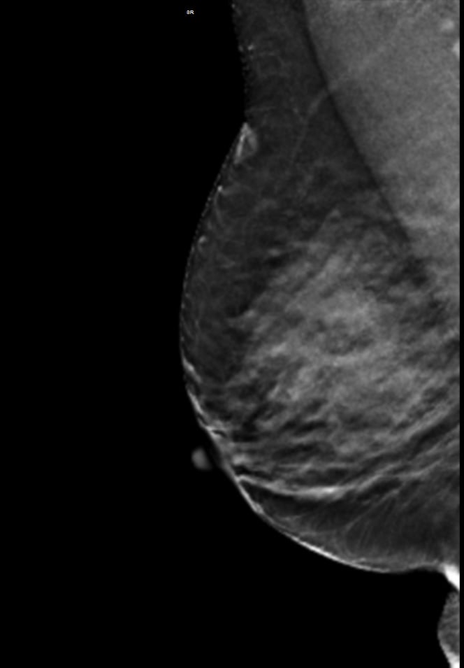 fibroglandular densities, dense breasts, 