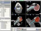 OncoView is an oncology-specific image management and storage solution that integrates images from diagnosis to radiation therapy, and in the same view provides data on the location where dose was delivered in a follow-up exam.