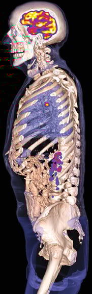 Nuclear Medicine is the New Personalized Medicine