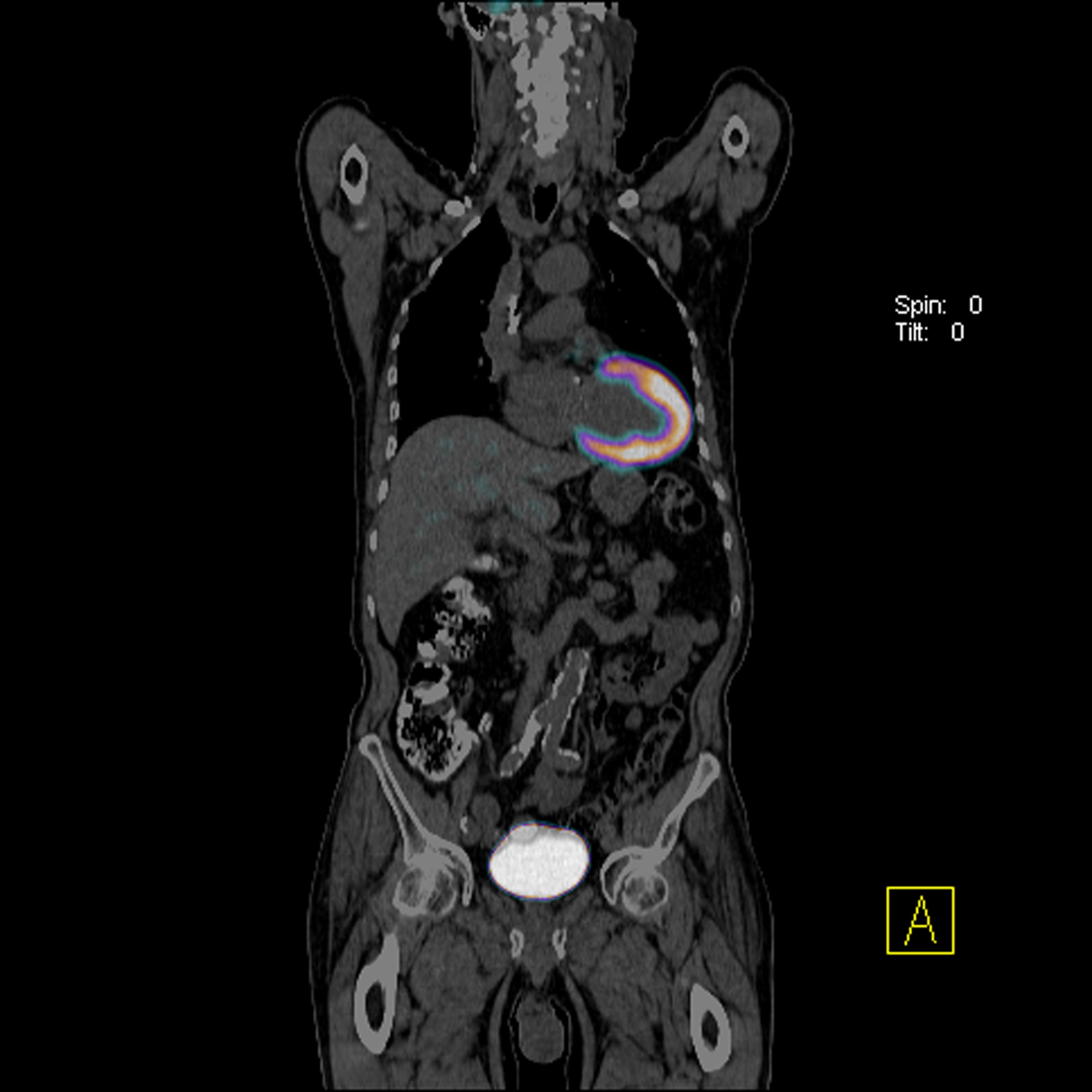 cardiac PET, myocardial perfusion, PET-CT, cardiac perfusion, nuclear imaging, molecular imaging, pet scanner