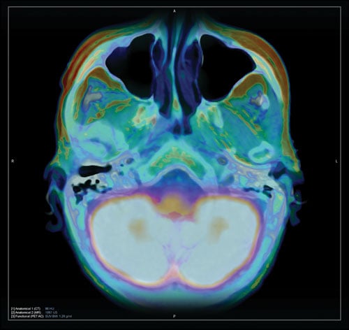 PET/CT