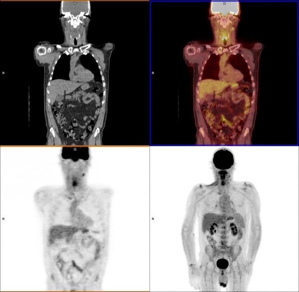 pet scan cancer