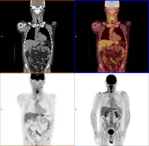 A PET/CT head and neck cancer scan.