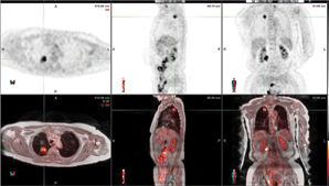 patient with lung cancer, MR/PET