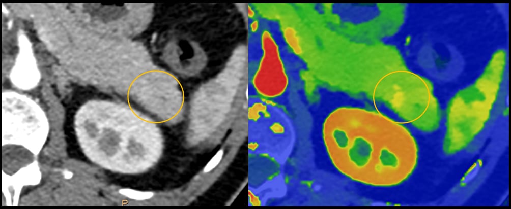 An example of how spectral CT can help aid diagnosis in a pancreatic CT which may have a small lesion, but it is difficult to see. The dual-energy imaging clearly shows a lesion. This is example is from the Philips Spectral CT 7500 system.