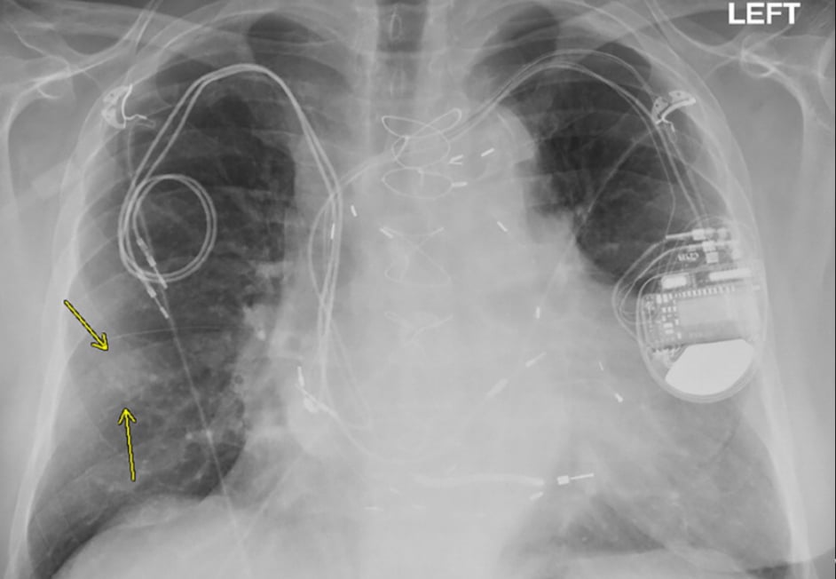 Chest X-ray from a patient included in the study. Posteroanterior view, of a 79-year-old man with history of a previous pacemaker, with abandoned right atrial and right ventricular pacing leads on the right side at time of new cardiac resynchronization therapy defibrillator implant on the left side. Arrows indicate a nodular opacity in the right midlung concerning for mass. Find more images of patients in this study in Radiology: Cardiothoracic Imaging.