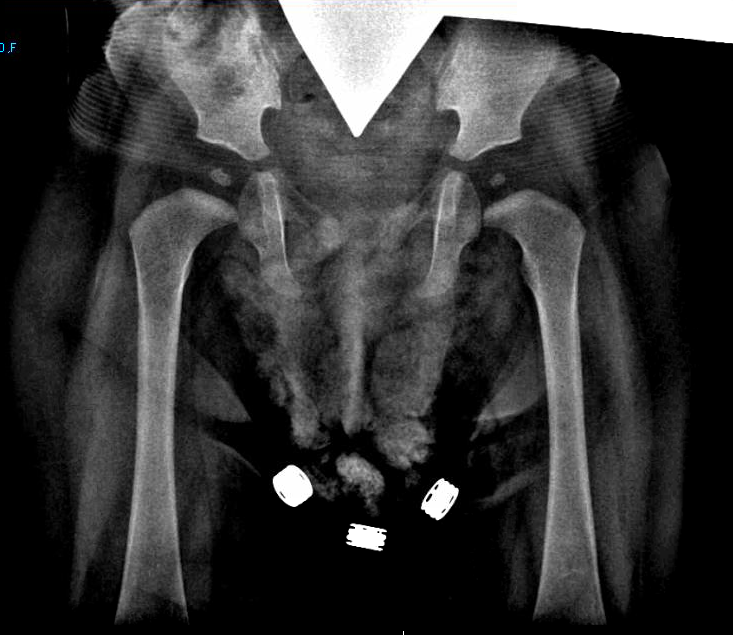 radiation exposure, CT, X-ray, cancer, James Welsh, Jeffry Siegel, Loyola