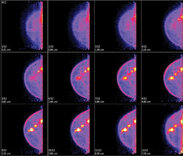 Example of molecular breast imaging (MBI) with breast cancer.