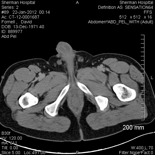 brachytherapy, ESTRO, radiotherapy, five-year recurrence, ASCENDE-RT