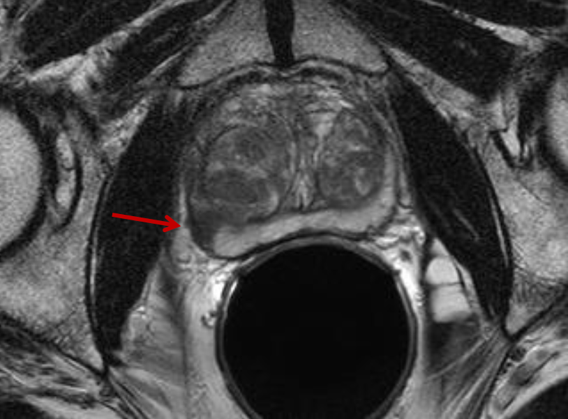 NEJM Exposes Overuse of Radiation Therapy Services When Urologists Profit Through Self-Referral