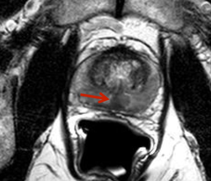 Radiation Therapy Prostate Cancer VMAT IMRT