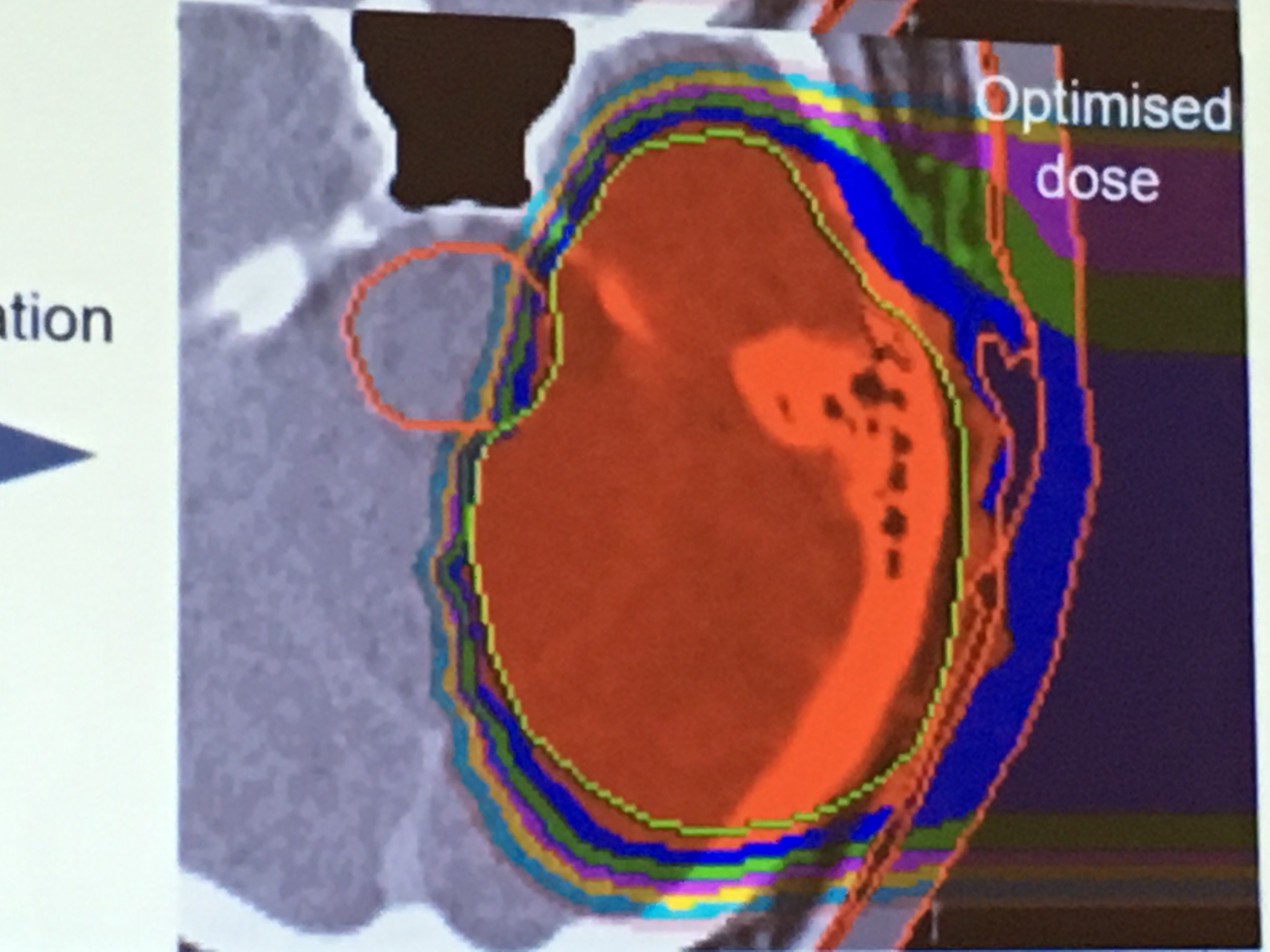 Six of the top 20 radiotherapy stories in 2019 involved proton therapy. This includes two video inetrviews shot during a site visit to the Northwestern Medicine Proton Center in the Chicago suburb of Warrenville, Ill.