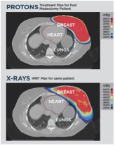 Proton therapy doesn’t get as near to the heart and other internal organs as X-ray therapy does. (Image courtesy of Provision Cares Proton Therapy Center.)