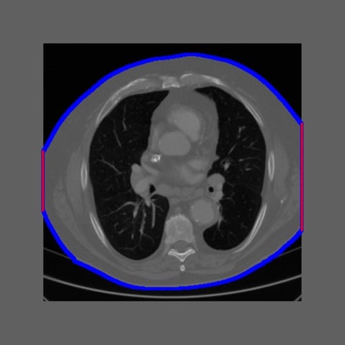 Example of an intentionally truncated CT image