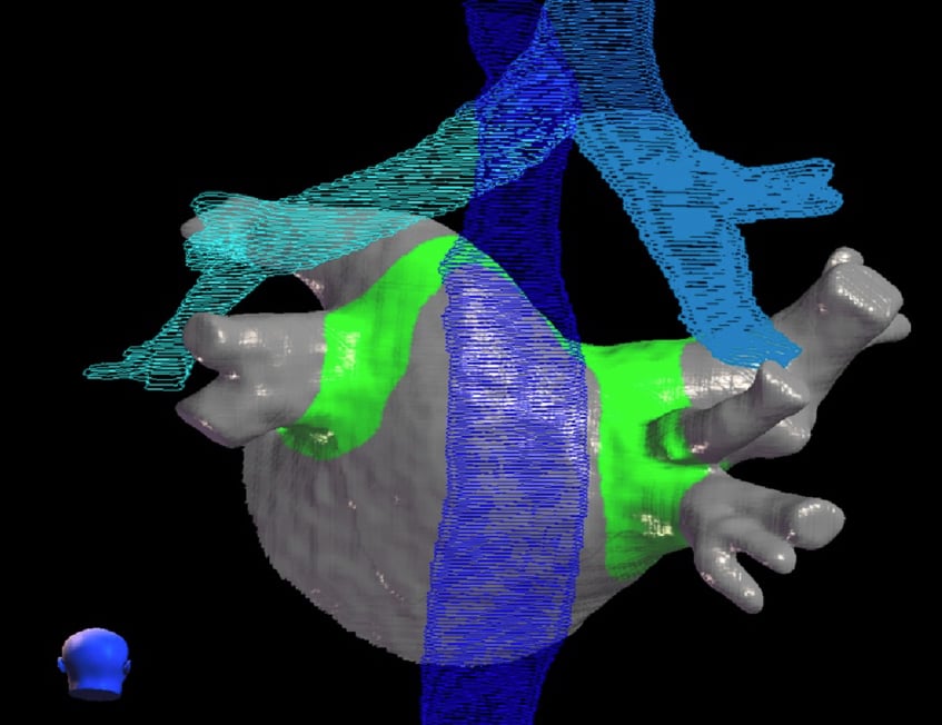 A CyberHeart cardiac ablation radiotherapy treatment plan showing where the radiation beams will ablate for a noninvasive pulmonary vein isolation, in green. The blue shows critical structures in the area around the heart that should be avoided by the radiation beam.