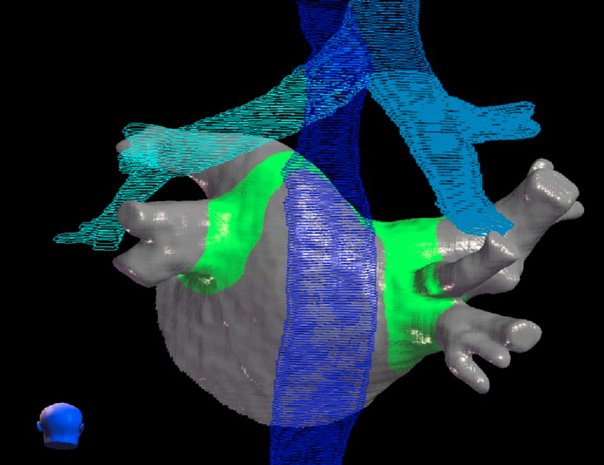 An example of a treatment plan for radio-ablation of the heart to noninvasively treat cardiac arrhythmias. This concept is one of the key presentations at the 2019 ASTRO meeting. Image courtesy of Cyberheart. #ASTRO19 #ASTRO2019 #ASTRO