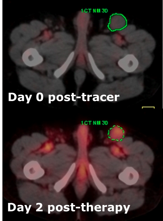 Radiation Test Run Predicts Outcome of Lymphoma Treatment