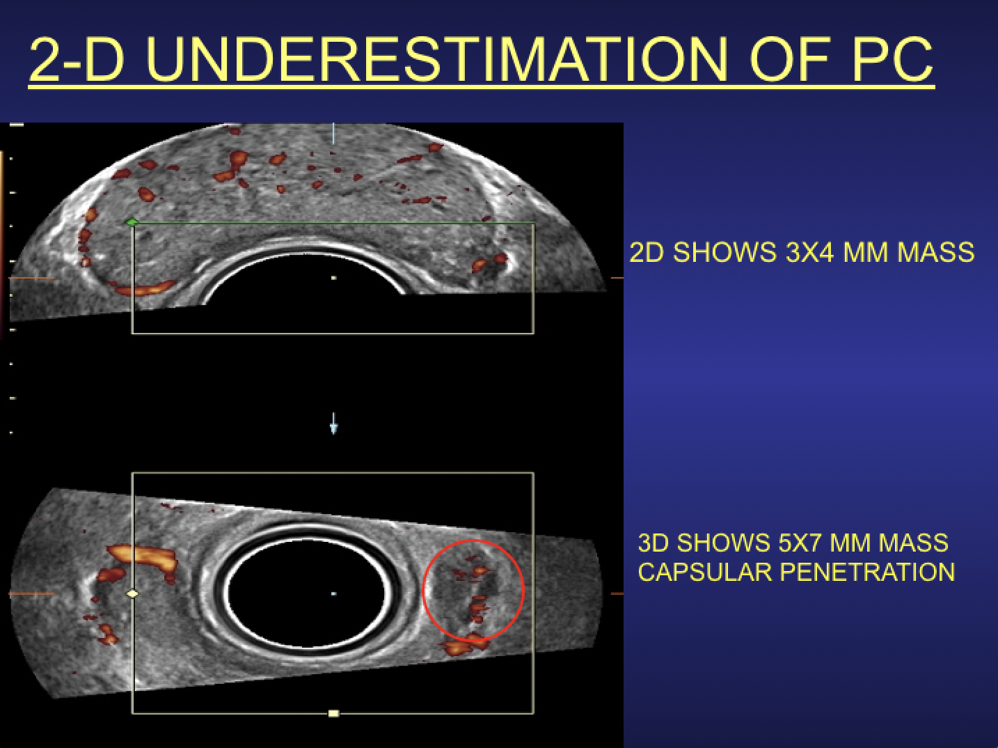 The irregularly marginated left tumor mass that bulges the lateral capsule appears three times the volume on the multiplanar 3-D/4-D image reconstruction and shows complete extraprostatic extension