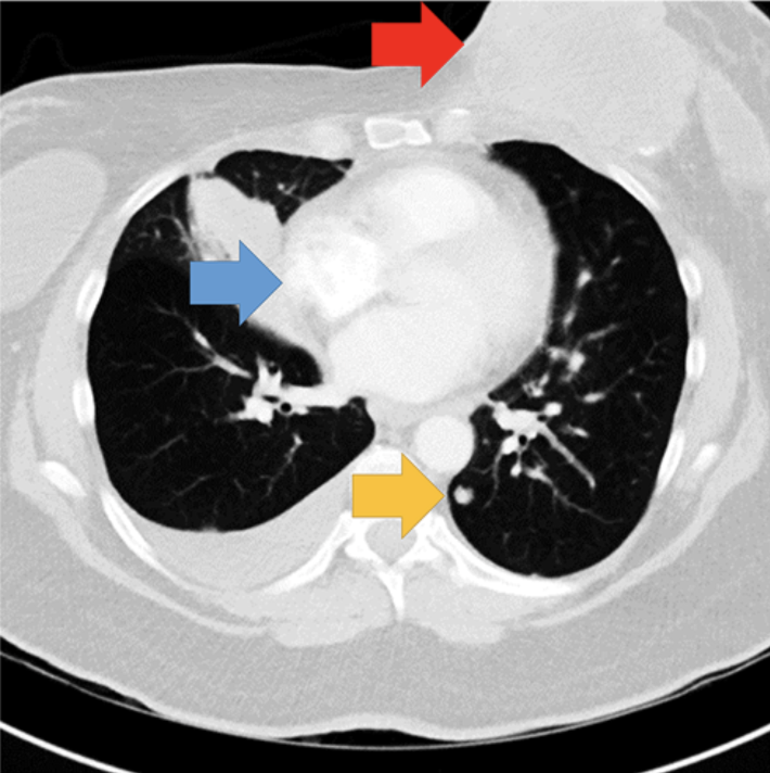 Single-slice of the chest CT showing the abnormalities. Arrows indicate the location of the breast mass (red arrow), lymphadenopathy (blue arrow), and a lung nodule (yellow arrow). Arrows not present in experimental display. Image courtesy of Psychonomic Bulletin & Review