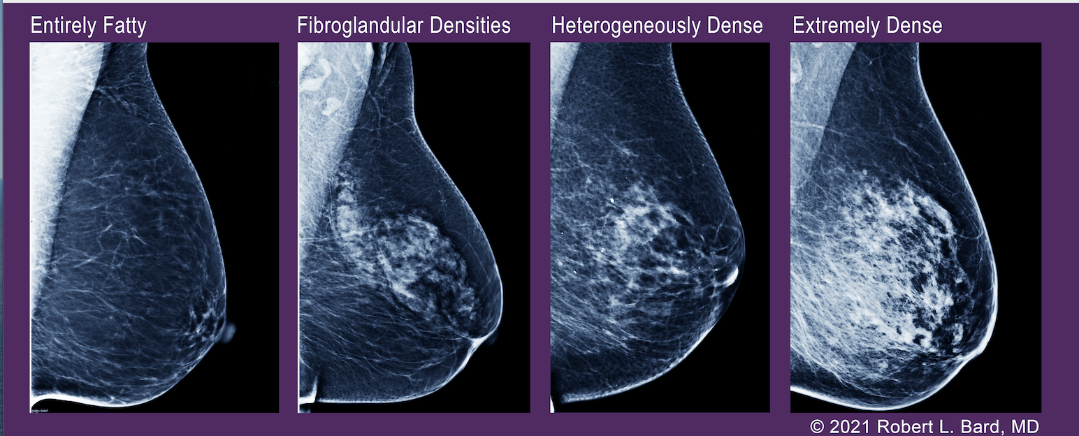 Breast density scale showing the varying degrees of breast density.