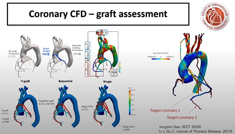 Sheer stresses on the walls of arteries are believed to cause the formation atherosclerotic plaques. This is an area of research that is expected to see increased use in the next few years. This study was presented at SCCT 2020 as an example of how sheer stresses can help evaluate and predict the patency of coronary artery bypass grafts (CABG).