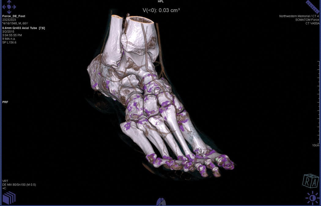CT Spectral imaging of a foot showing gout. The image was made on a Somatom Force dual energy CT system.