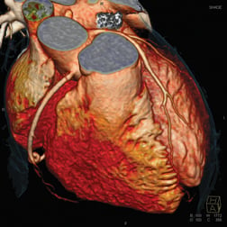 A 3-D rendering of a cardiac CT angiography imaged by a Siemens Somatom Definition Flash CT scanner.