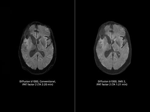 Siemens Healthineers simultaneous Multi-Slice (SMS) acquires multiple diffusion tensor imaging (DTI) slices simultaneously.