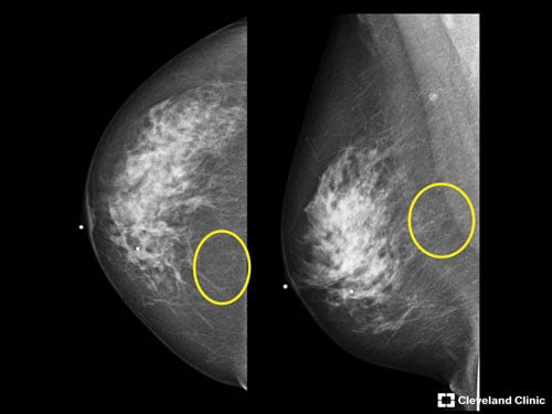 stereotactic breast imaging
