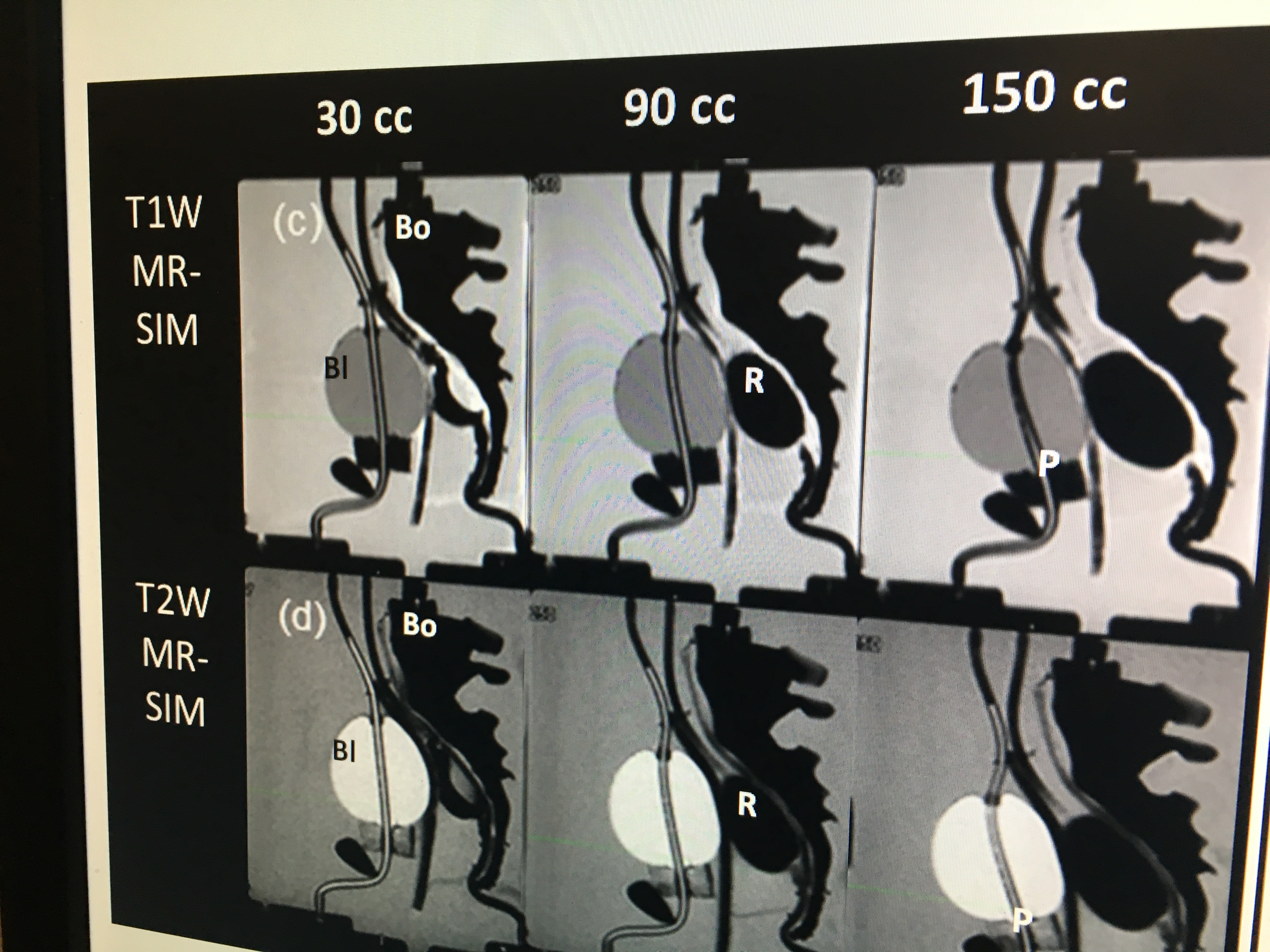 A set of synthetic CT images created from T1 and T2 weighted MR imaging of a prostate/rectum phantom at Henry Ford Hospital. The hospital is one of the research centers developing  synthetic CT imaging for treatment planning to avoid the need for CT scans of a patient just for treatment planning purposes when they already have a more detailed soft tissue MRI exam of  the anatomy.