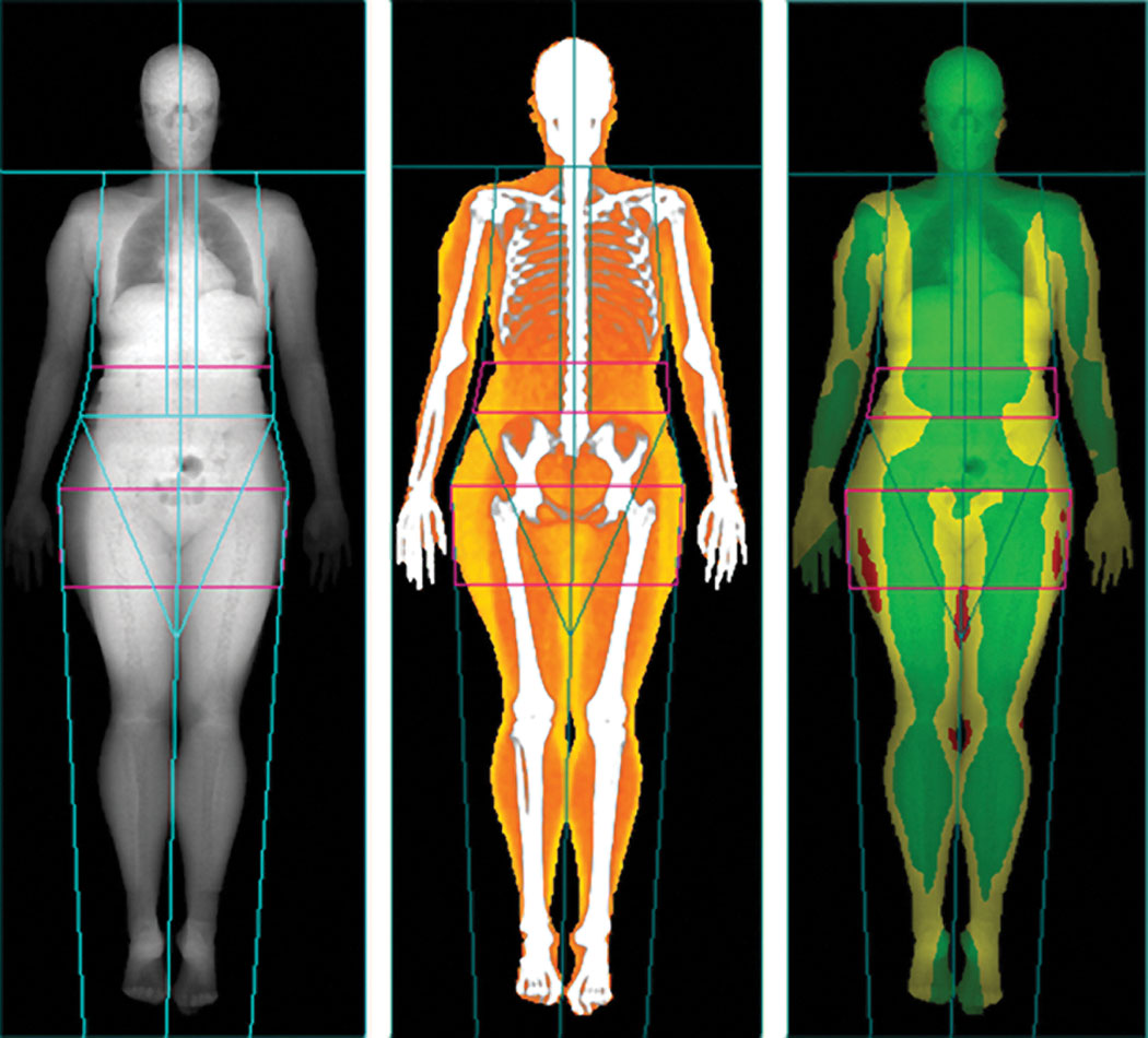 Body scans, Lunar iDXA