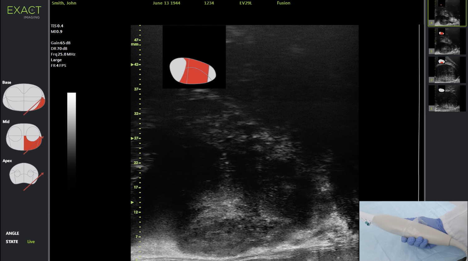 Detecting Prostate Cancer With Advanced Micro Ultrasound Imaging Technology News