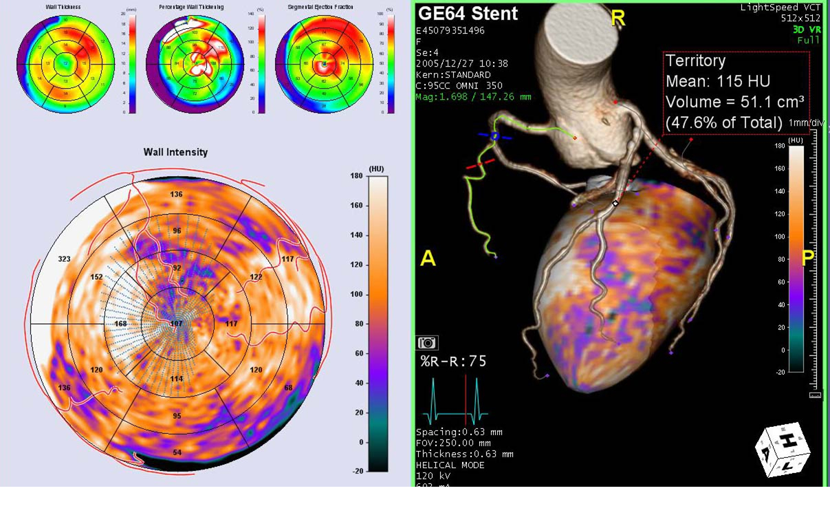 TeraRecon Lesion-Specific Analysis