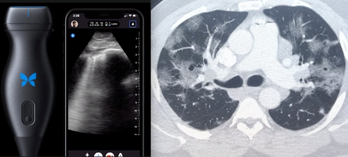 The top two videos on ITN for the year both involved medical imaging of COVID using point of care ultrasound (POCUS) and mass movement to teleradiology to enable remote working for radiologists and virtual collaboration with referring physicians. The image on the left is Butterfly's POCUS system that turns a smart phone into an ultrasound machine and the image is of COVID B-lines in the lung. The image on the right is a CT scan of COVID pneumonia. #COVID19