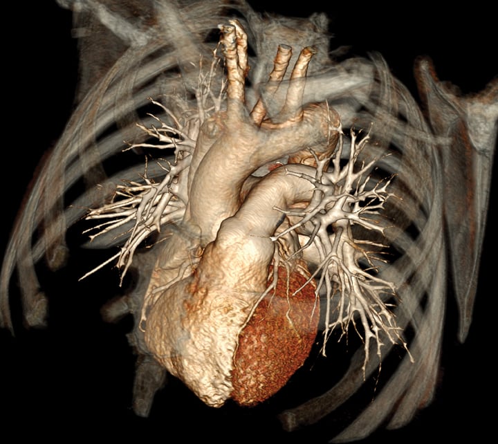 High-Quality, Low-Dose CTA Imaging