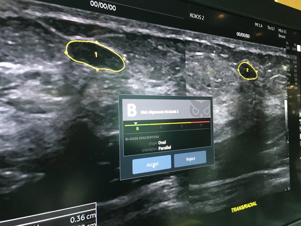 A work in progress artificial intelligence app for assessment of breast ultrasound lesions on the Logiq E10 system.
