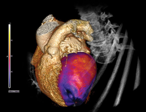 CT perfusion