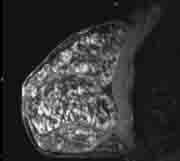 Breast MRI images can help identify tumors in dense breast tissue that might be obscured on traditional mammography.