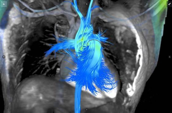 Arterys, Cardiac MRI, cardiac MRI advances
