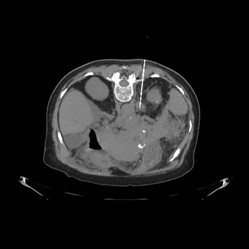 Medicare Costs Analysis Indicates Need for Decreasing Use of Biopsies as Diagnosis Tool for Lung Cancer