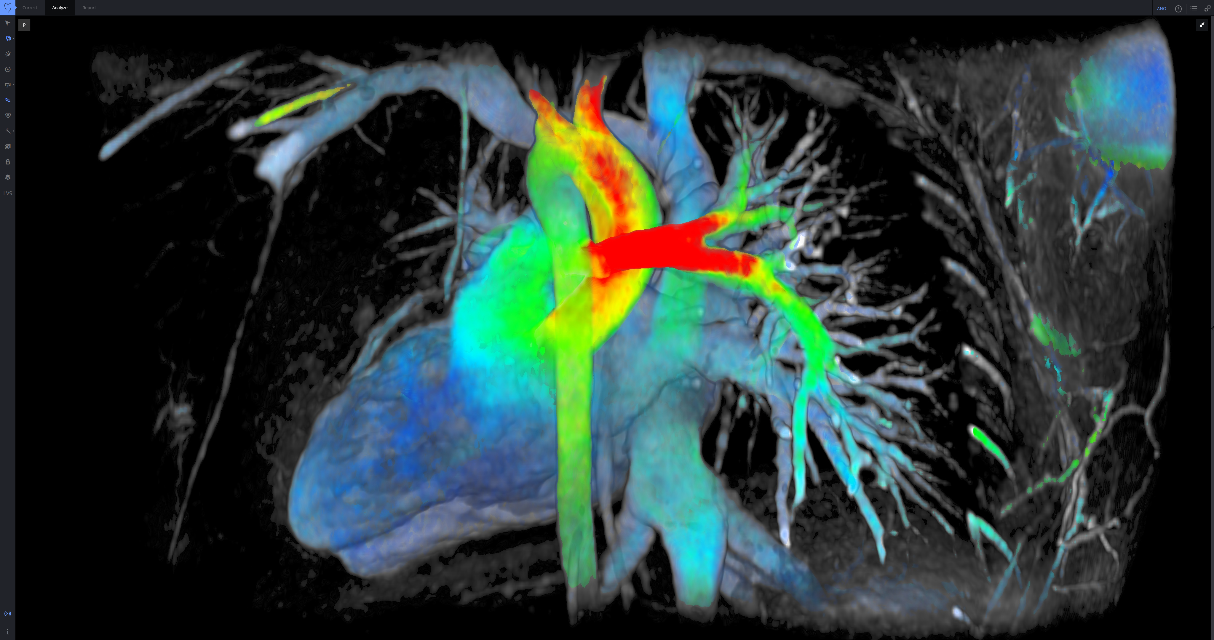 GE ViosWorks, now with Arterys software, large image datasets of the whole chest can be post processed and evaluated in real-time via cloud technology.