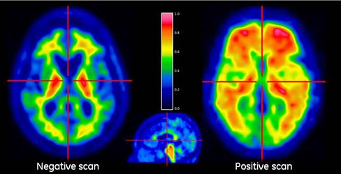 focused ultrasound, Alzheimer's, mice, Queensland, treatment