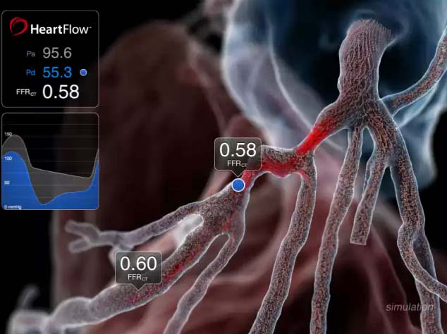 CT-FFR, Heartflow Analysis, coronary artery disease, EuroPCR, RIPCORD