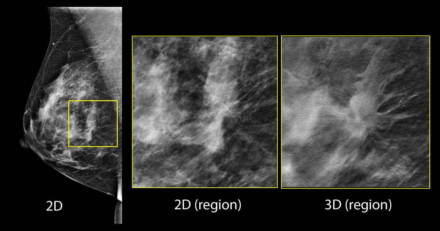 tomosynthesis, 3D mammography