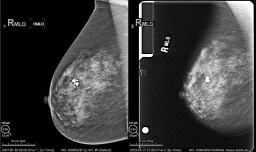 digital mammography