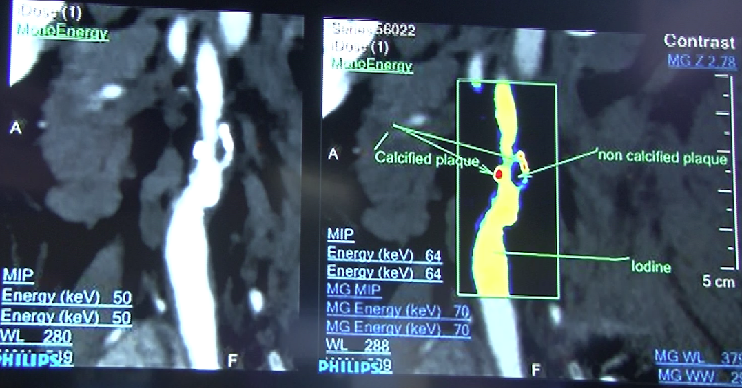 spectral CT, IQon