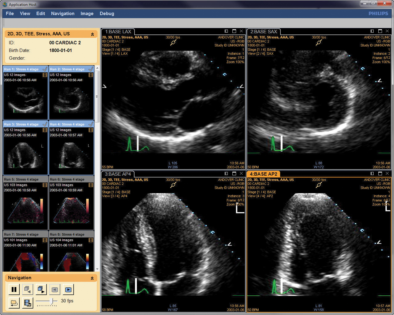 ultrasound, market, cardiovascular, 3-D, 4-D, United States, U.S.