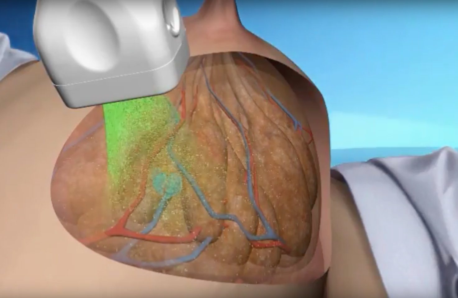 An example of opto-acoustic breast imaging using the Seno system.   